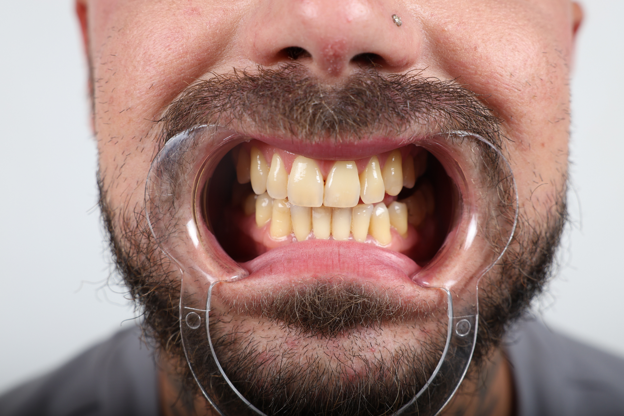 Before Zirconia Crown Treatment